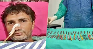 অস্ত্রোপচারে পেটে মিলল ২৯ স্টিলের চামচ, ১৯ টুথব্রাশ-২ কলম