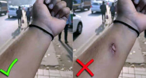 আহত হাতের ছবি দিয়ে অফিস থেখে ছুটি নিলেন কর্মী