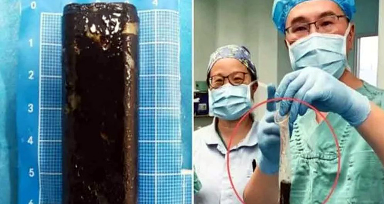 রোগীর পেট থেকে বের করা হলো সিগারেটে আগুন ধরানোর লাইটার