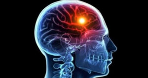 অল্প বয়সেই বাড়ছে যে কারণে স্ট্রোকের ঝুঁকি