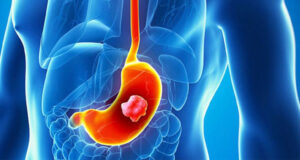 গ্যাস্ট্রিকের যন্ত্রণা রক্ষায় জীবনযাত্রায় ৫ পরিবর্তন