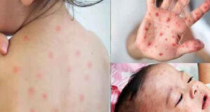 গত ২৪ ঘন্টায় হামের উপসর্গ নিয়ে ৪ শিশুর মৃত্যু