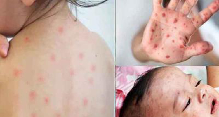 গত ২৪ ঘন্টায় হামের উপসর্গ নিয়ে ৪ শিশুর মৃত্যু