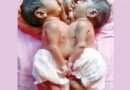 জোড়ালাগা যমজ সন্তান নিয়ে দ্বারে দ্বারে ঘুরছেন দরিদ্র বাবা-মা