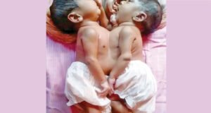 জোড়ালাগা যমজ সন্তান নিয়ে দ্বারে দ্বারে ঘুরছেন দরিদ্র বাবা-মা
