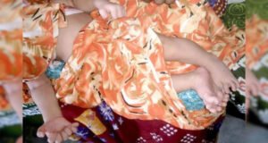 হাত-পায়ে ২৮ আঙুল নিয়ে কন্যাশিশুর জন্ম!